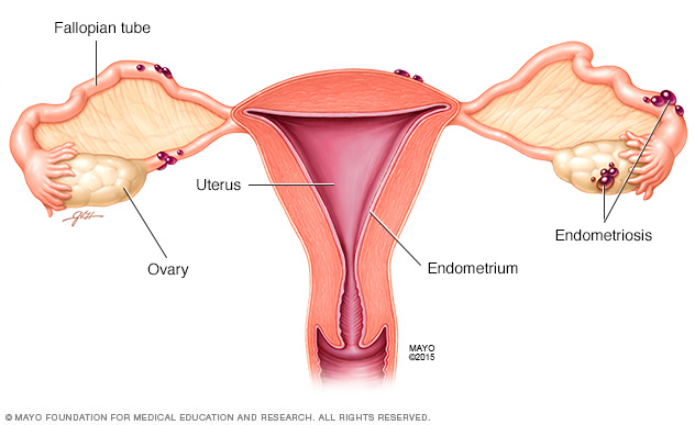 Endometriosis Perlu Ditangani Agar Berpeluang Mendapat Zuriat My Life Ria